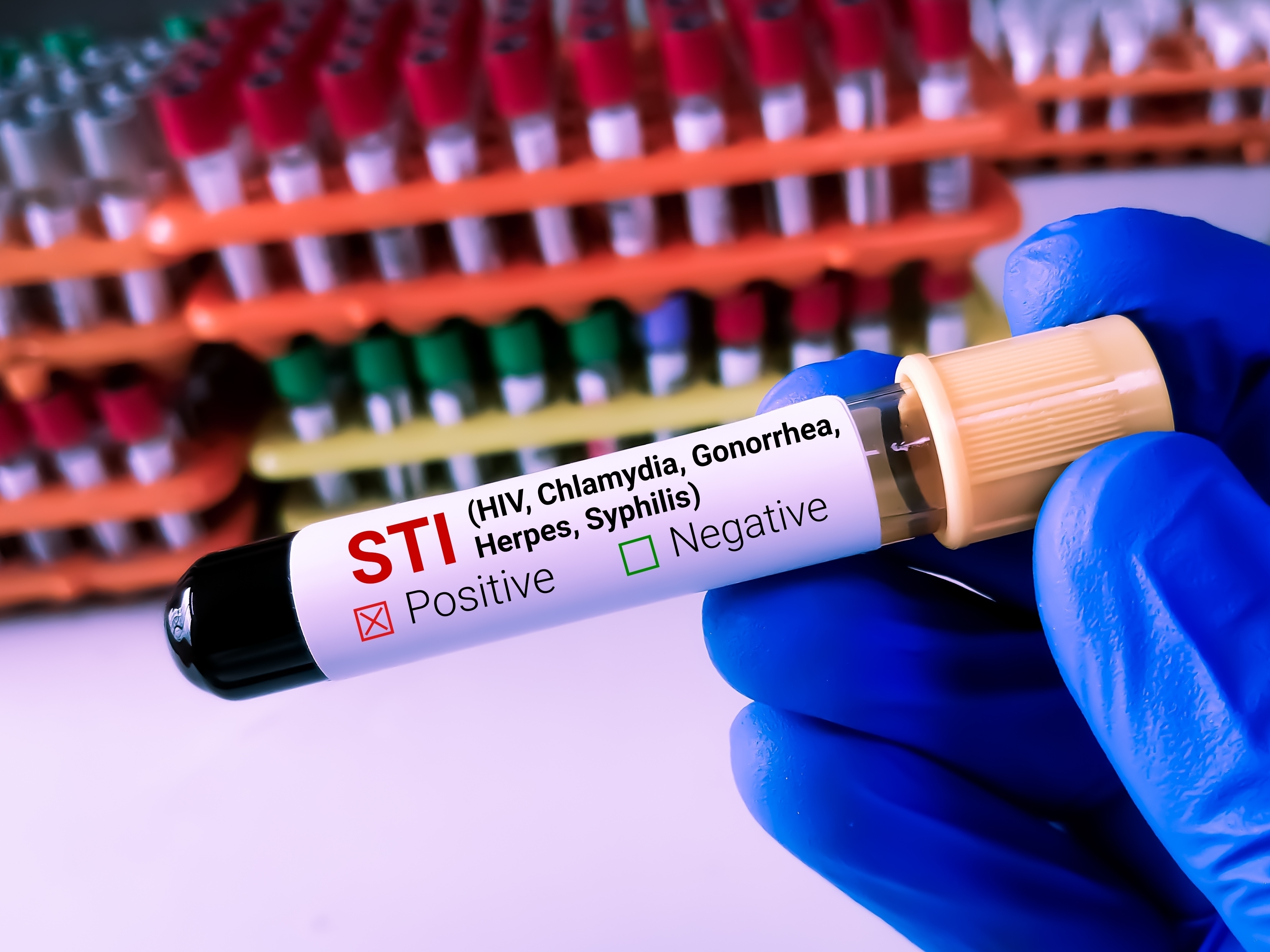 Biochemist,Or,Lab,Technologist,Holds,Blood,Sample,For,Sti,Or